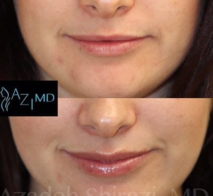 Lips Before & After Lip Rejuvenation
