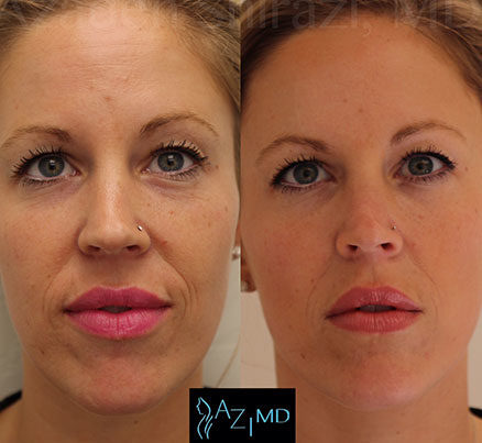 Woman Before & After Laser Treatment