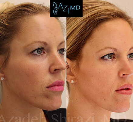 Profile Of Woman Before & After Laser Treatment