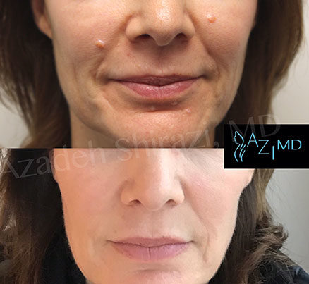 Woman Before & After Mole Removal Procedure