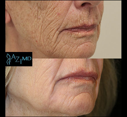 Woman's Lip Area Before & After Laser Peel Treatment
