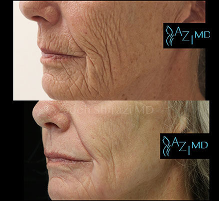Woman Before & After Dermatologist Laser Peel