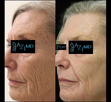 Older Woman Before & After Chemical Peel Treatment