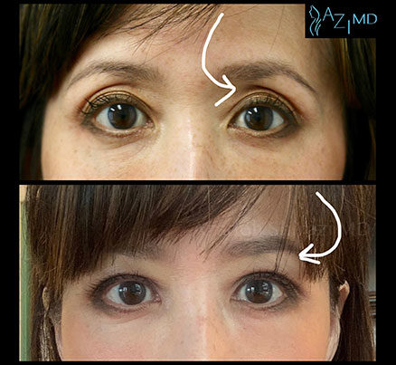 Woman's Eyes Before & After Eye Rejuvenation With EyeGlow