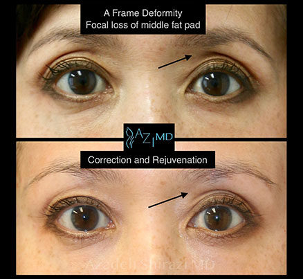 Woman Before & After Under Eye Rejuvenation With EyeGlow