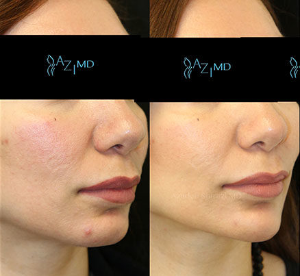 Woman's Face Before & After Facial Contouring Fillers