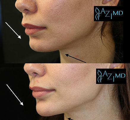 Woman Before & After Facial Contouring Fillers