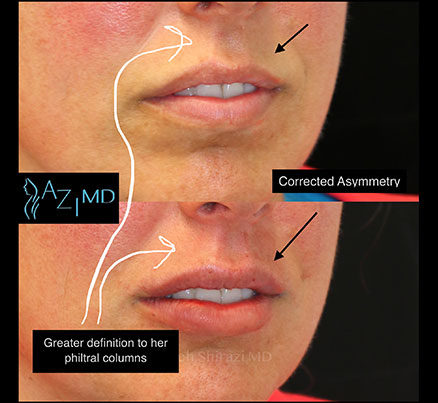 Woman Before & After Lip Threading