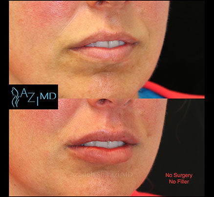 Woman's Lips Before & After Lip Threading