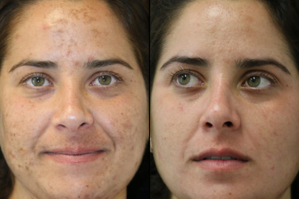 Melasma