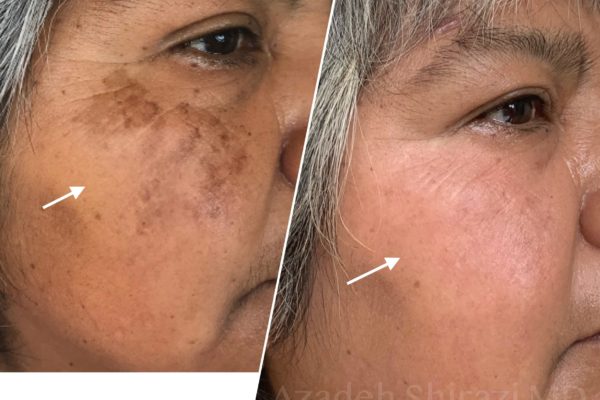 Melasma2
