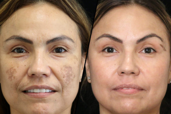 Melasmabeforeafter1