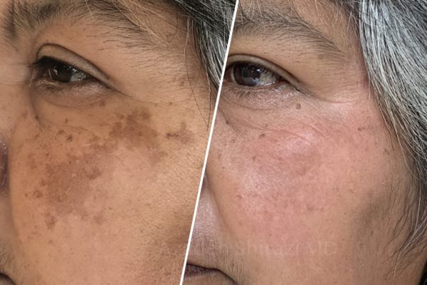 Melasma2(1)