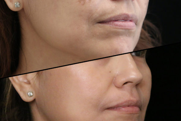 Melasma3