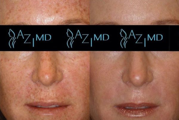 Woman's Face Before & After Photodynamic Therapy For Freckles