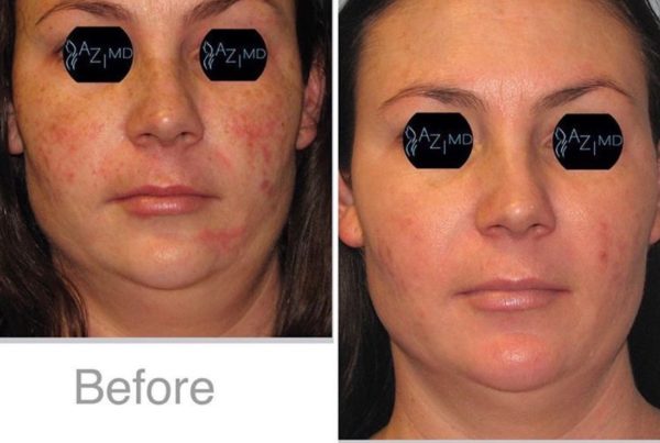 Woman's Face Before & After Photodynamic Therapy For Acne