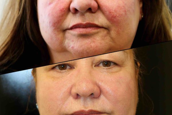 Woman's Face Before & After Photodynamic Therapy