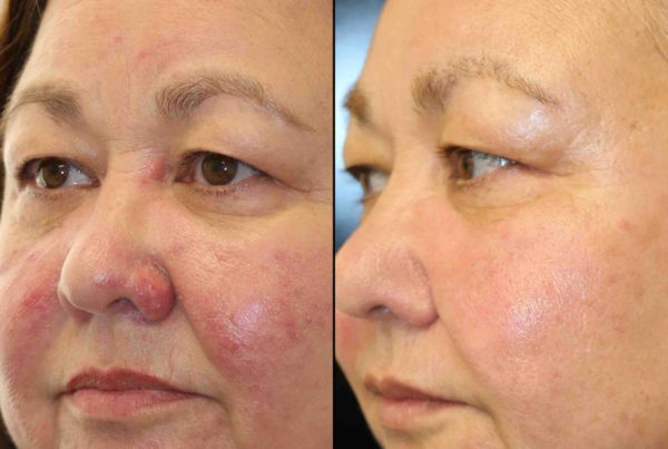 Woman Before & After Photodynamic Therapy For Acne