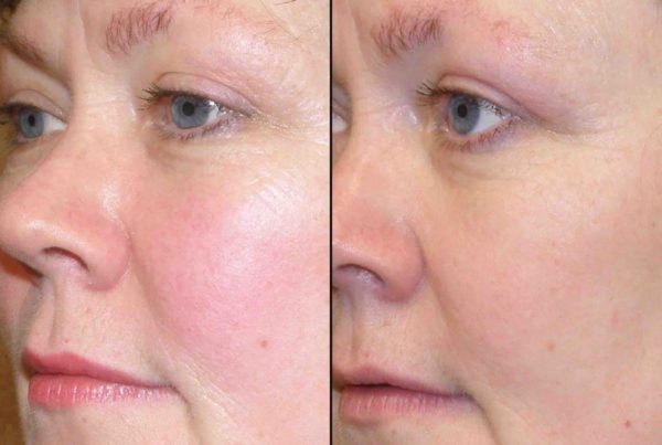 Before & After Photodynamic Therapy