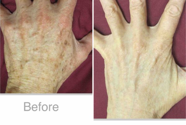 Hand Before & After Photodynamic Therapy