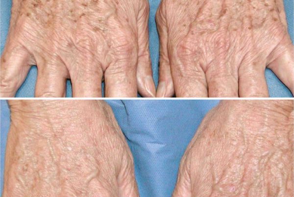 Before & After Photo Hand Rejuvenation Treatment