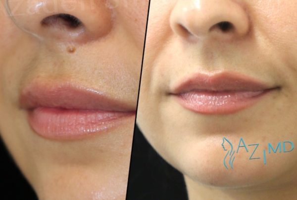 Woman After Laser Mole Removal Procedure