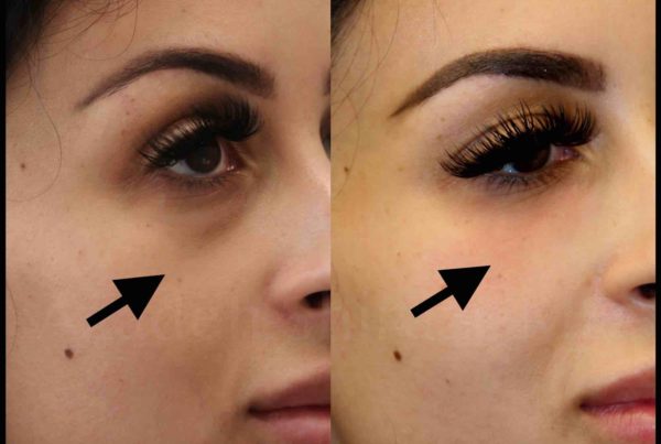 Woman Before & After Under Eye Treatment