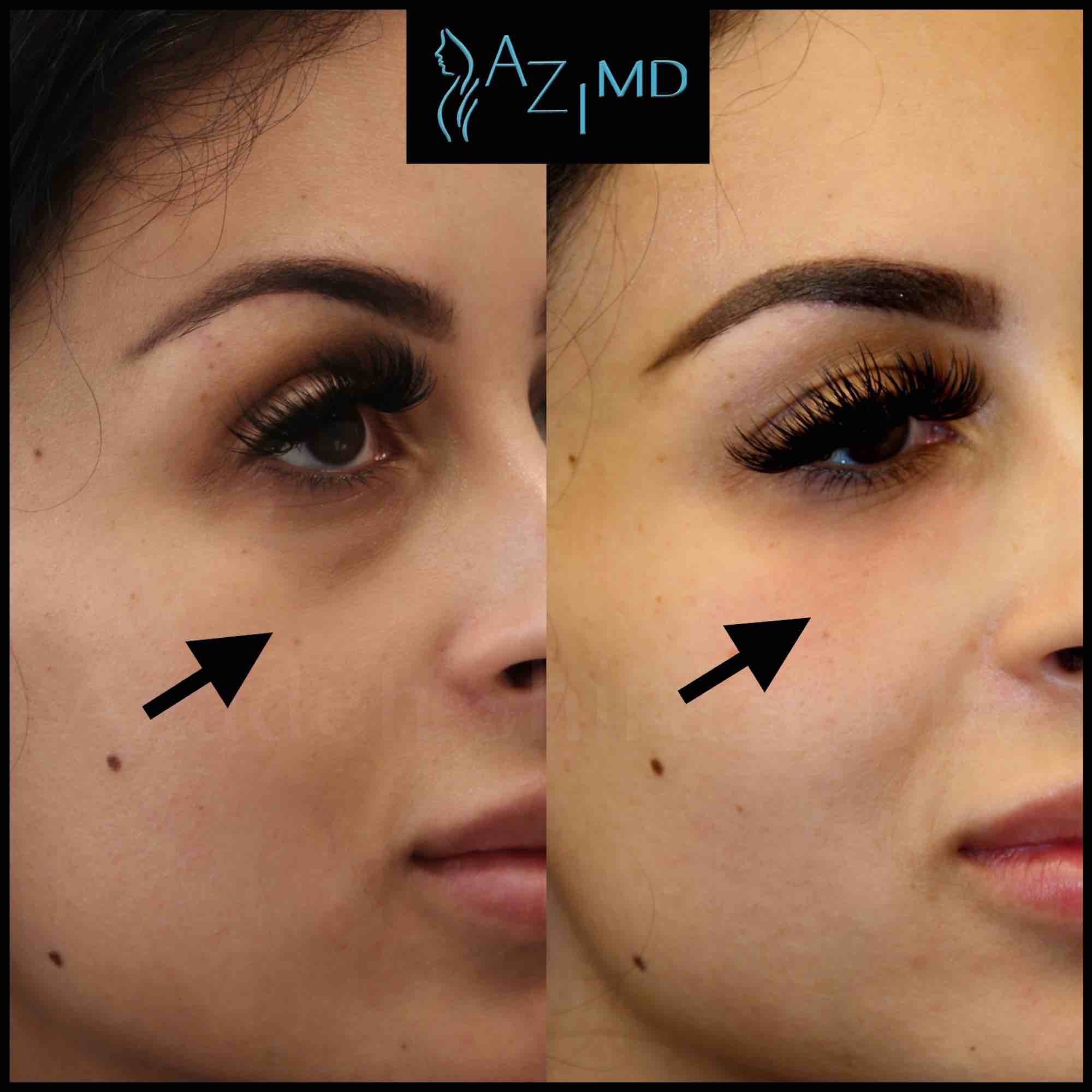 Woman Before & After Under Eye Treatment