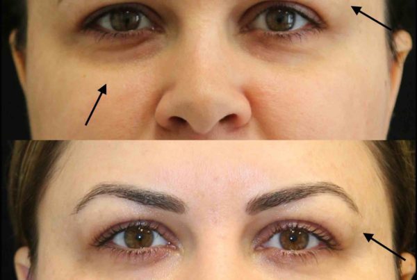 Woman Before & After Under Eye Rejuvenation & Eye Lid Lift Fillers