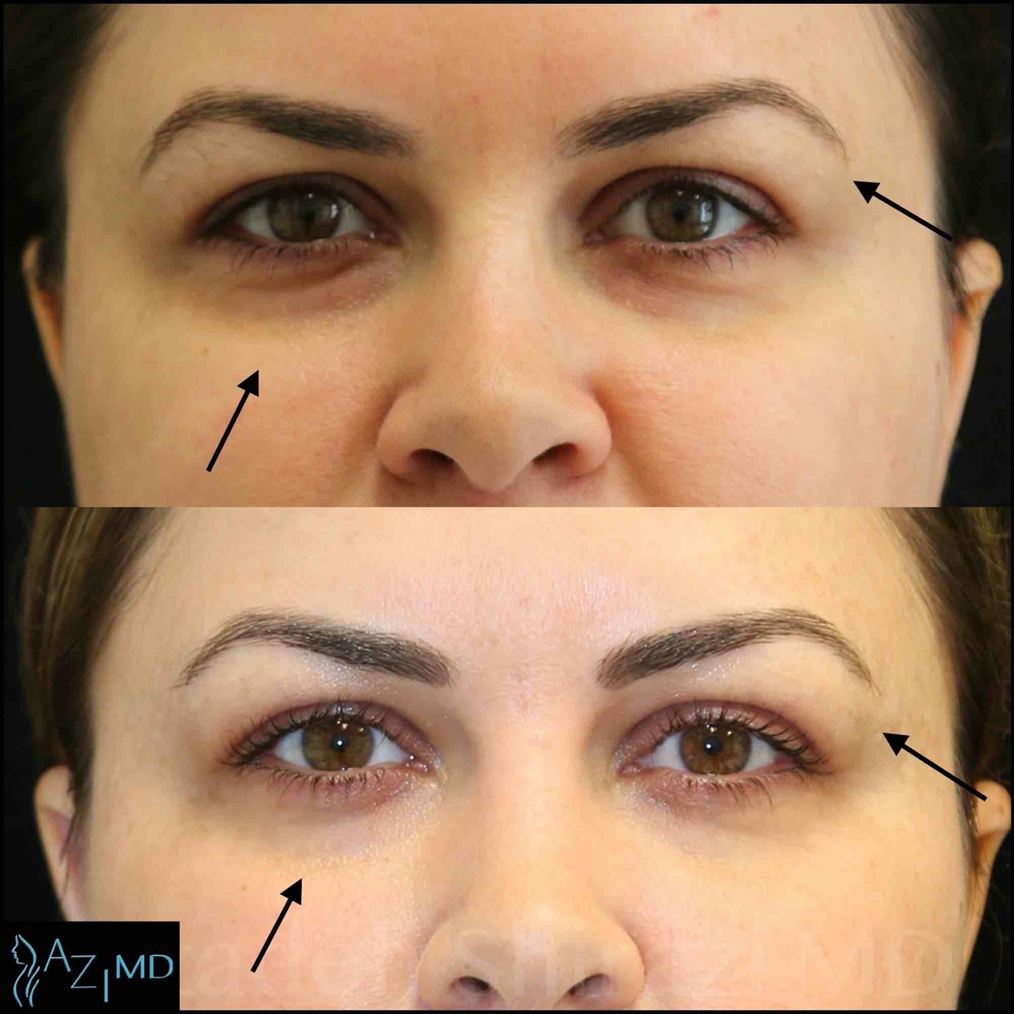 Woman Before & After Under Eye Rejuvenation & Eye Lid Lift Fillers