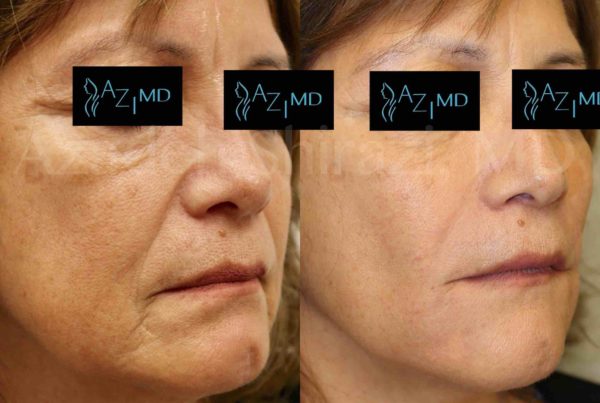 Side Of Woman Before & After Deep Wrinkle Treatment