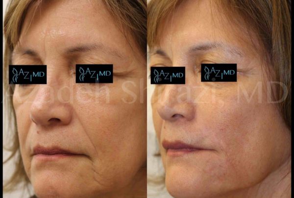 Woman Before & After Using A Juvederm Filler