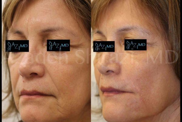 Before & After Of Mini Face Lift Procedure