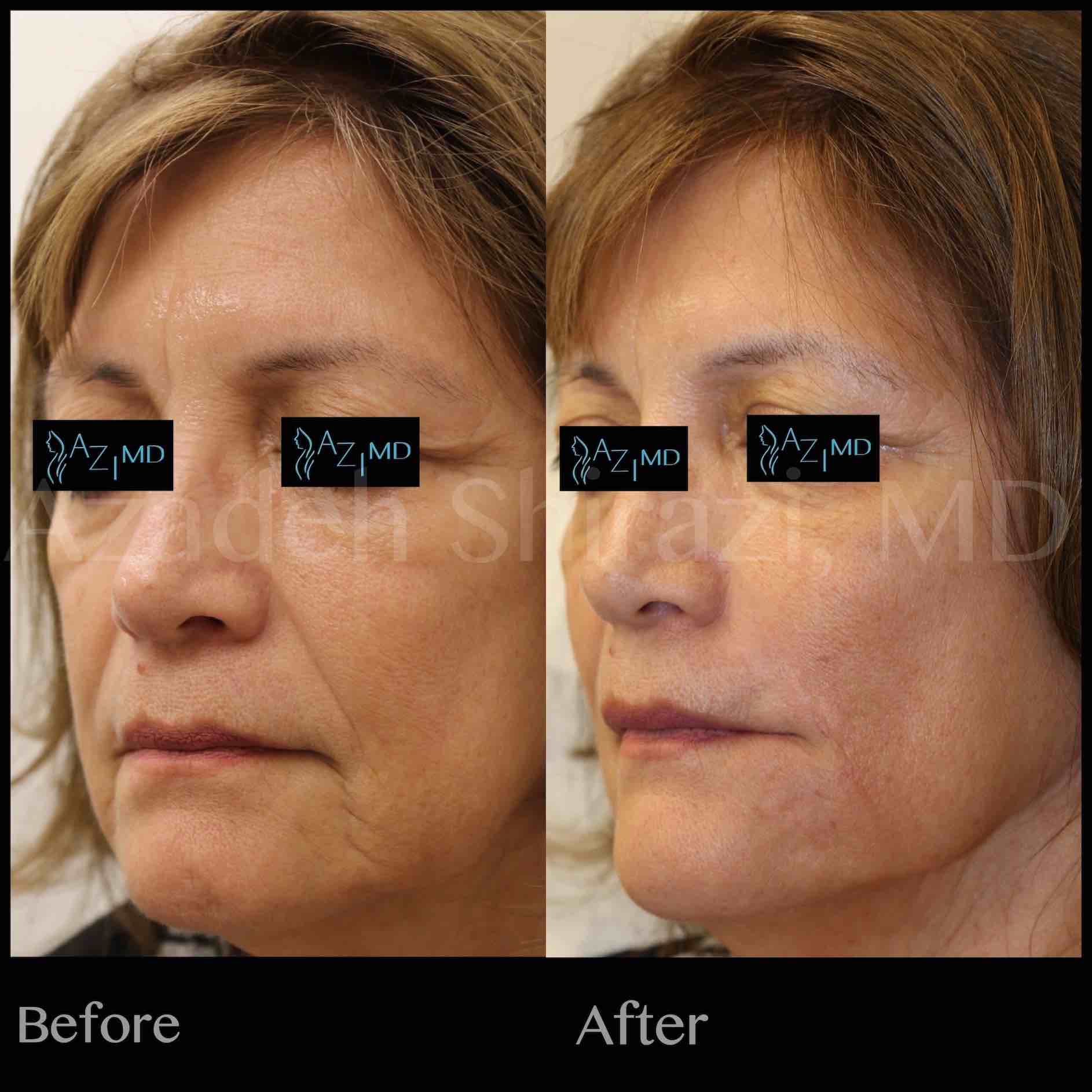 Before & After Of Mini Face Lift Procedure