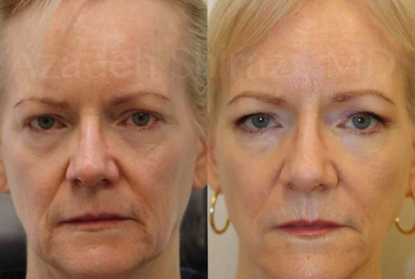 Before & After Of Woman After Dermal Filler Injections