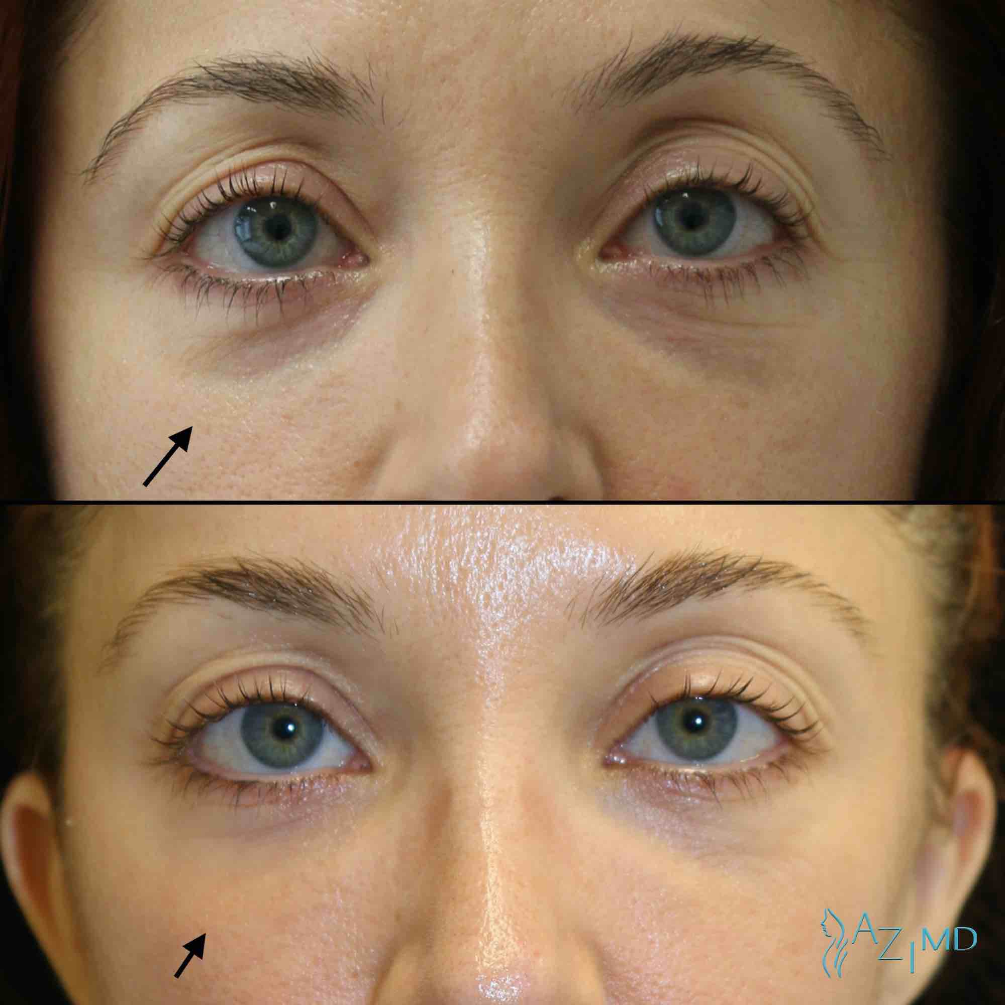 Before & After Eye Lid Lift
