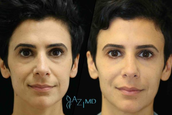 Woman After Deep Wrinkle Treatment