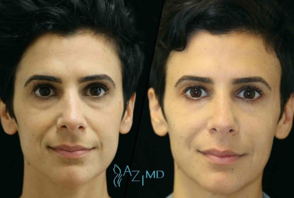 Person Before & After Using Cosmetic Fillers For Face