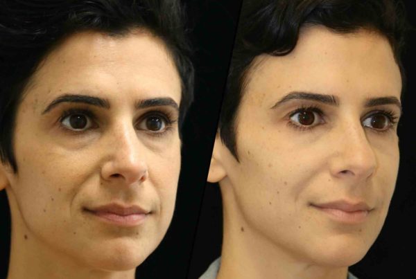 Side Of Woman Before & After Under Eye Treatment