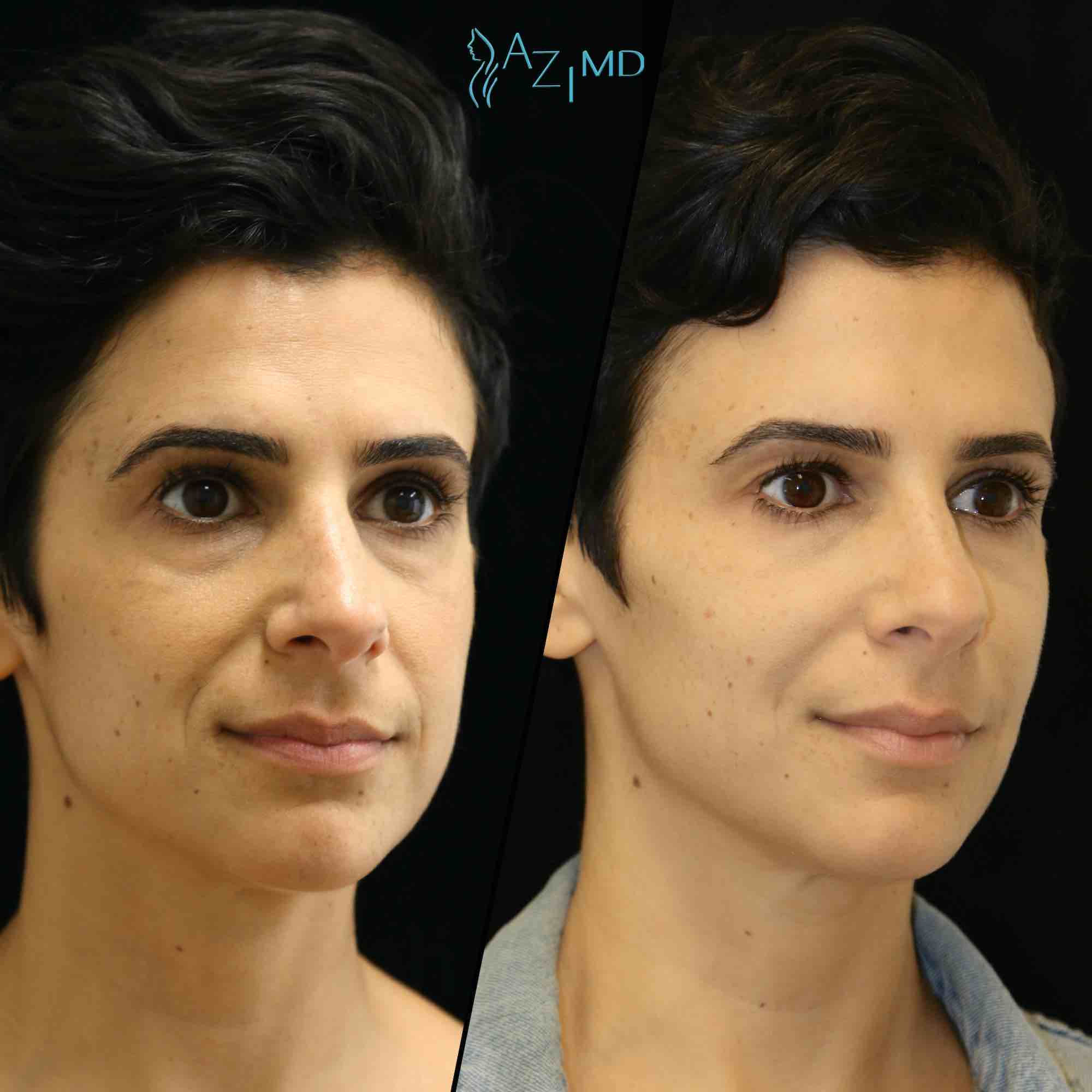 Side Of Woman Before & After Under Eye Treatment