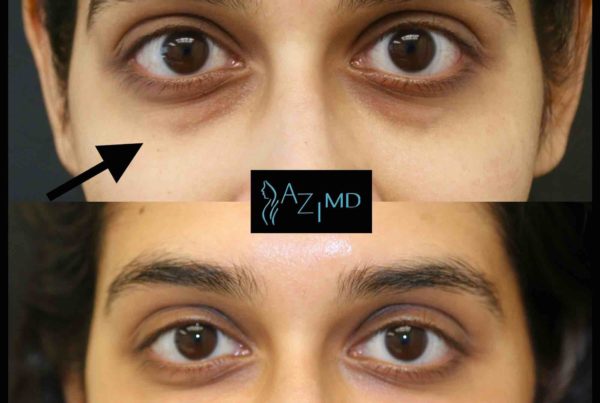 Results Of Under Eye Rejuvenation