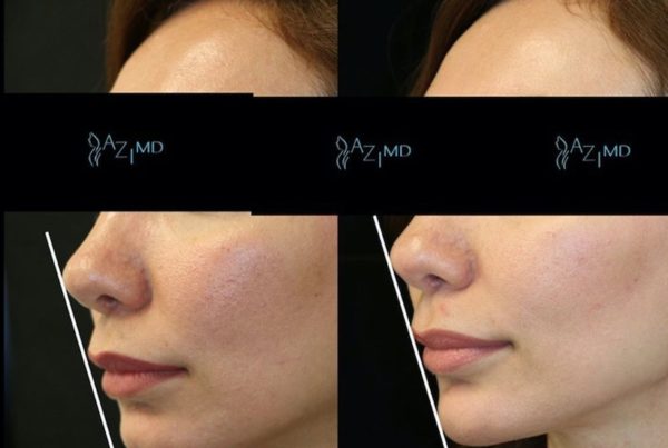 Profile Of Woman Before & After Non Surgical Chin Augmentation
