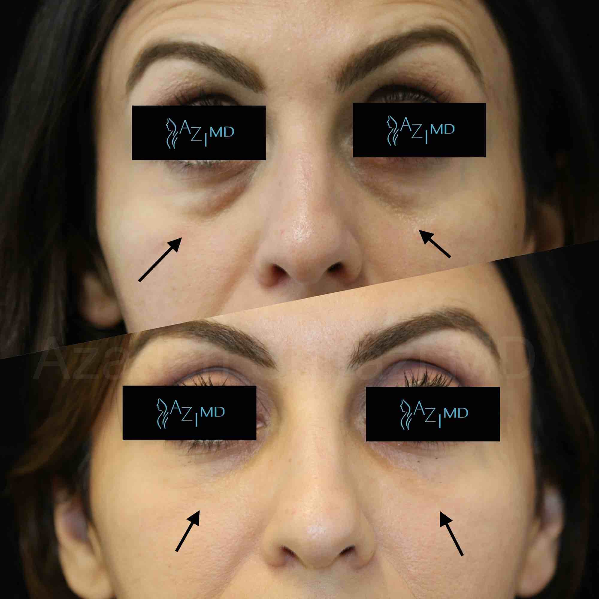 Before & After Results Of Under Eye Rejuvenation