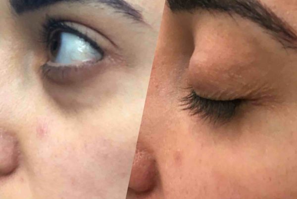 Person Before & After Eye Rejuvenation
