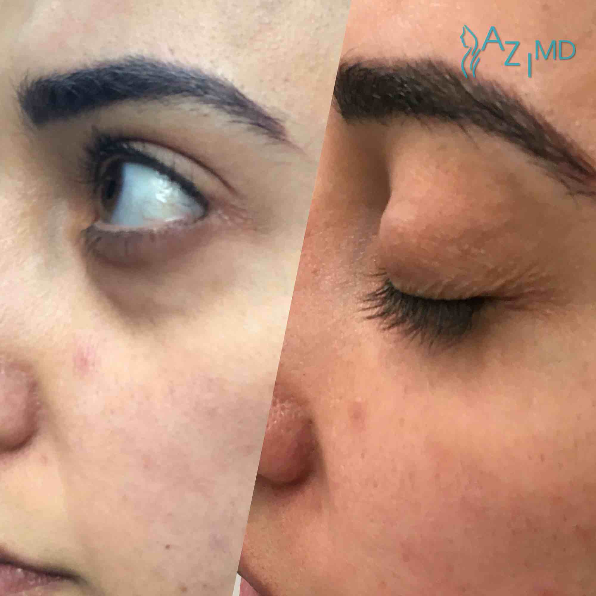 Person Before & After Eye Rejuvenation