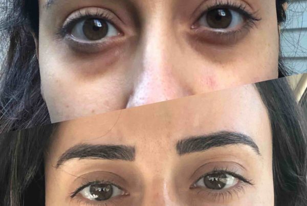 Woman Before & After Under Eye Rejuvenation