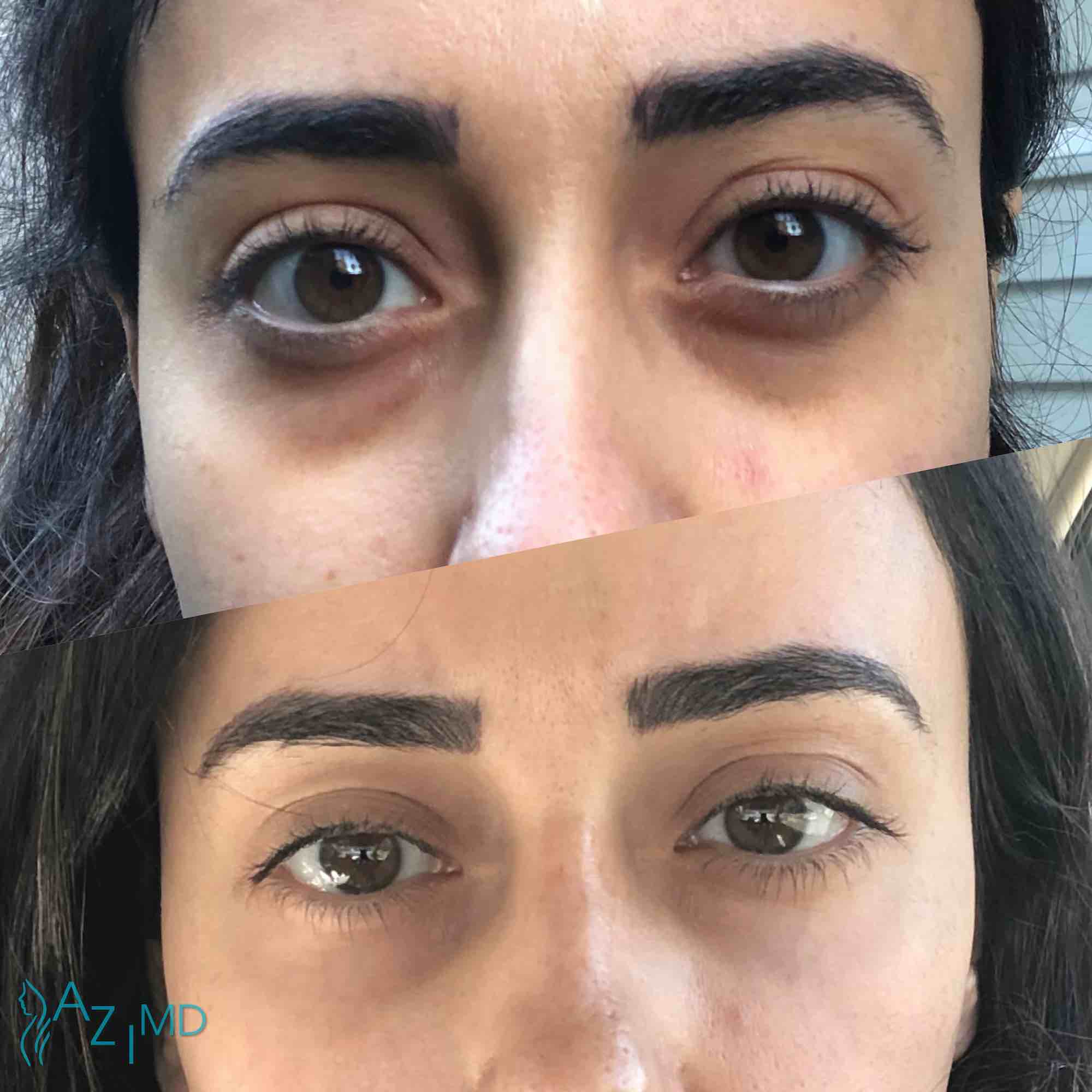 Woman Before & After Under Eye Rejuvenation