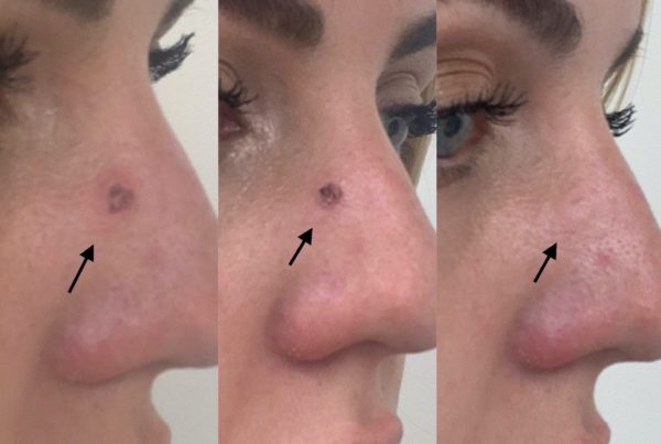 Profile Of Woman After Laser Mole Removal Procedure