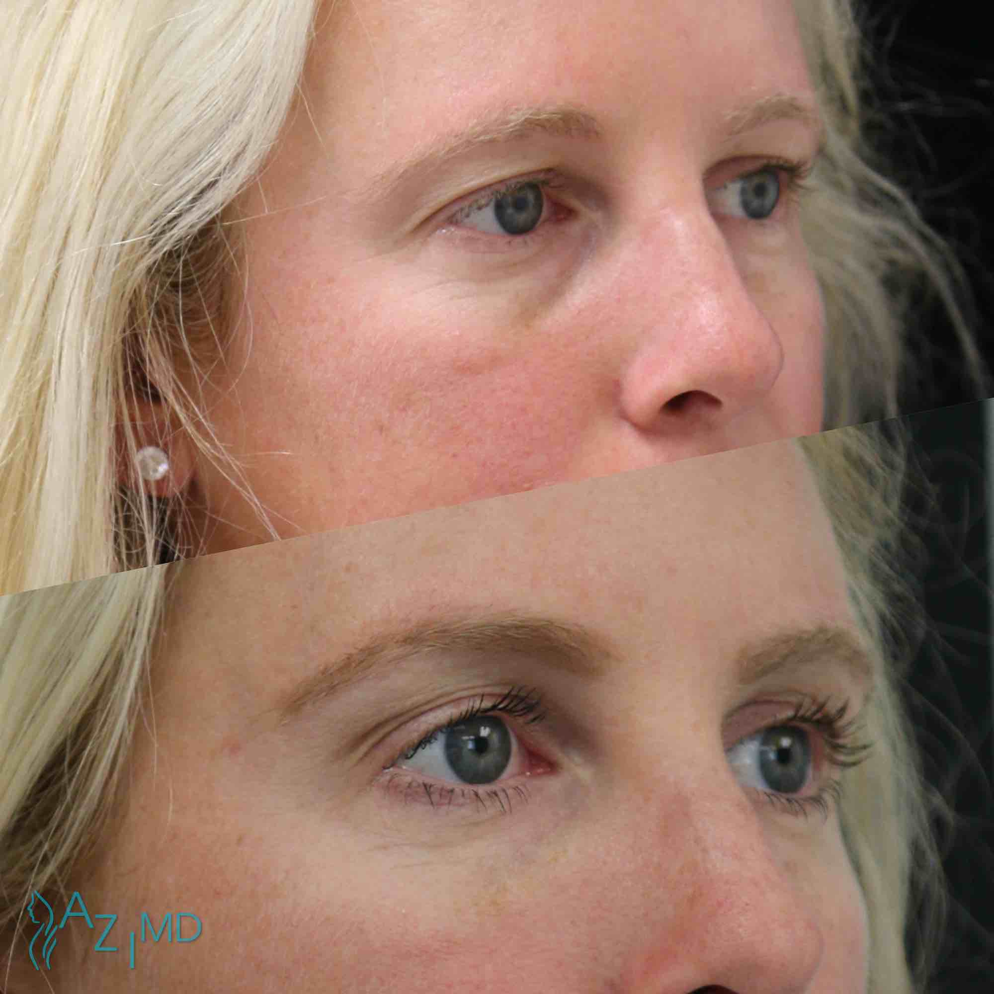 Lady Before & After Eye Lid Lift Without Surgery