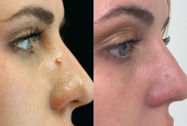 Profile Of Woman After Laser Mole Removal Procedure
